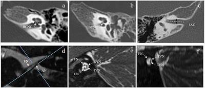 Value of Preoperative Imaging Results in Predicting Cochlear Nerve Function in Children Diagnosed With Cochlear Nerve Aplasia Based on Imaging Results